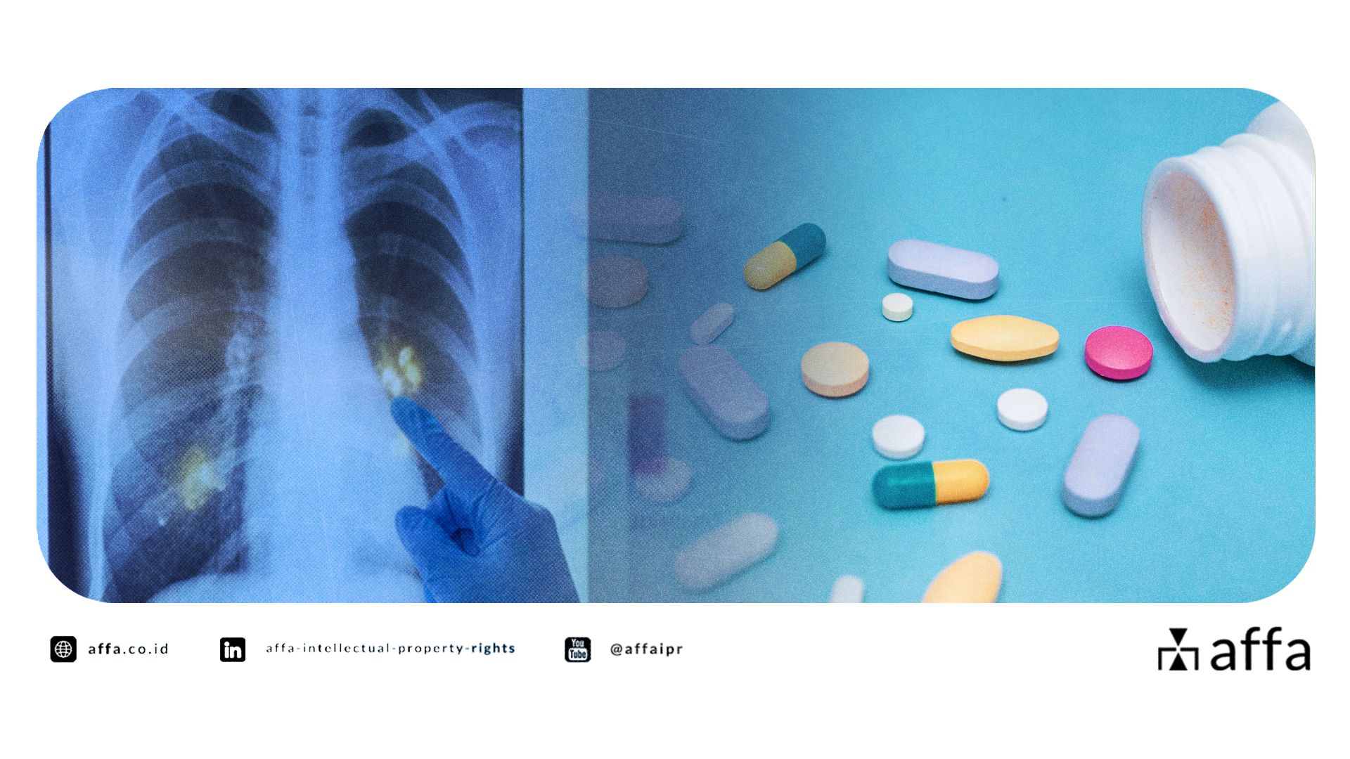 A New Wave of Tuberculosis R&D in Indonesia: Industry Must Stay Alert—Drug Patents Are Heating Up! - AFFA IPR